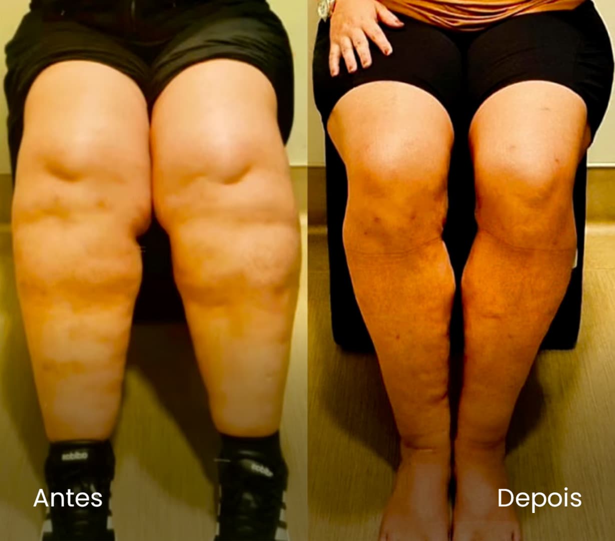 Antes e depois de paciente com lipedema atendida por alunos do Lipedema Academy — caso 01