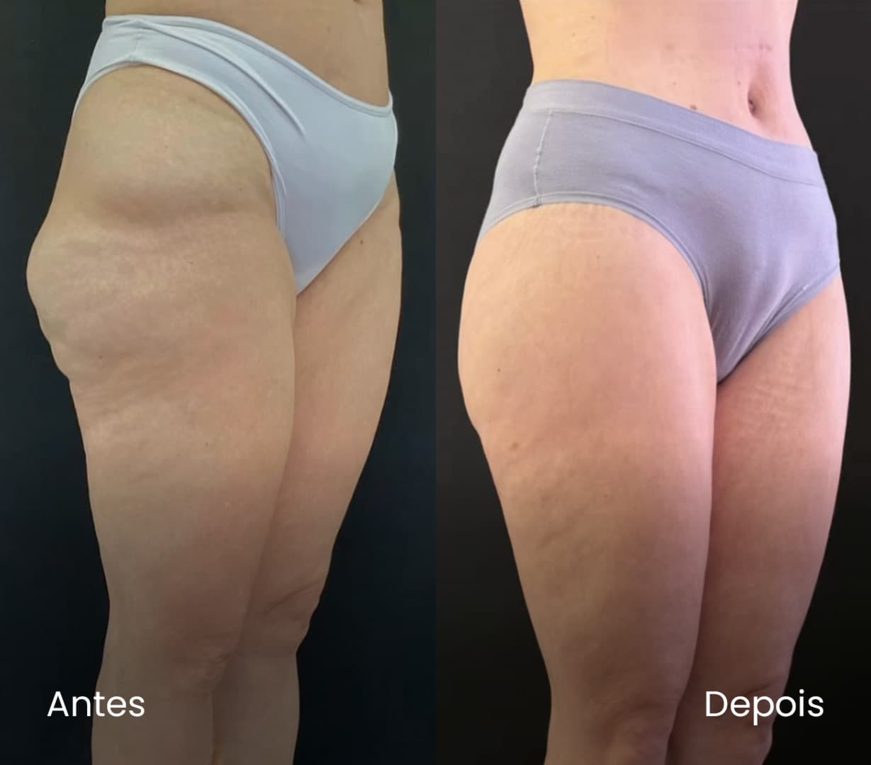 Antes e depois de paciente com lipedema atendida por alunos do Lipedema Academy — caso 02