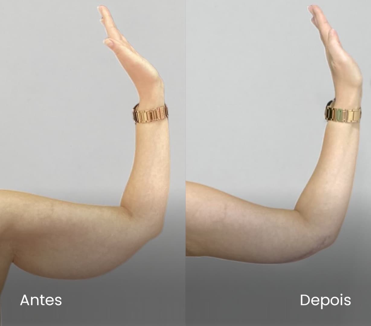 Antes e depois de paciente com lipedema atendida por alunos do Lipedema Academy — caso 03
