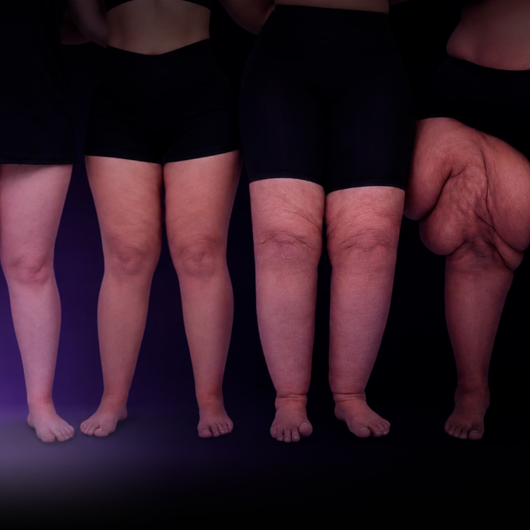 Protocolo Lipedema — formação médica de base do Lipedema Academy